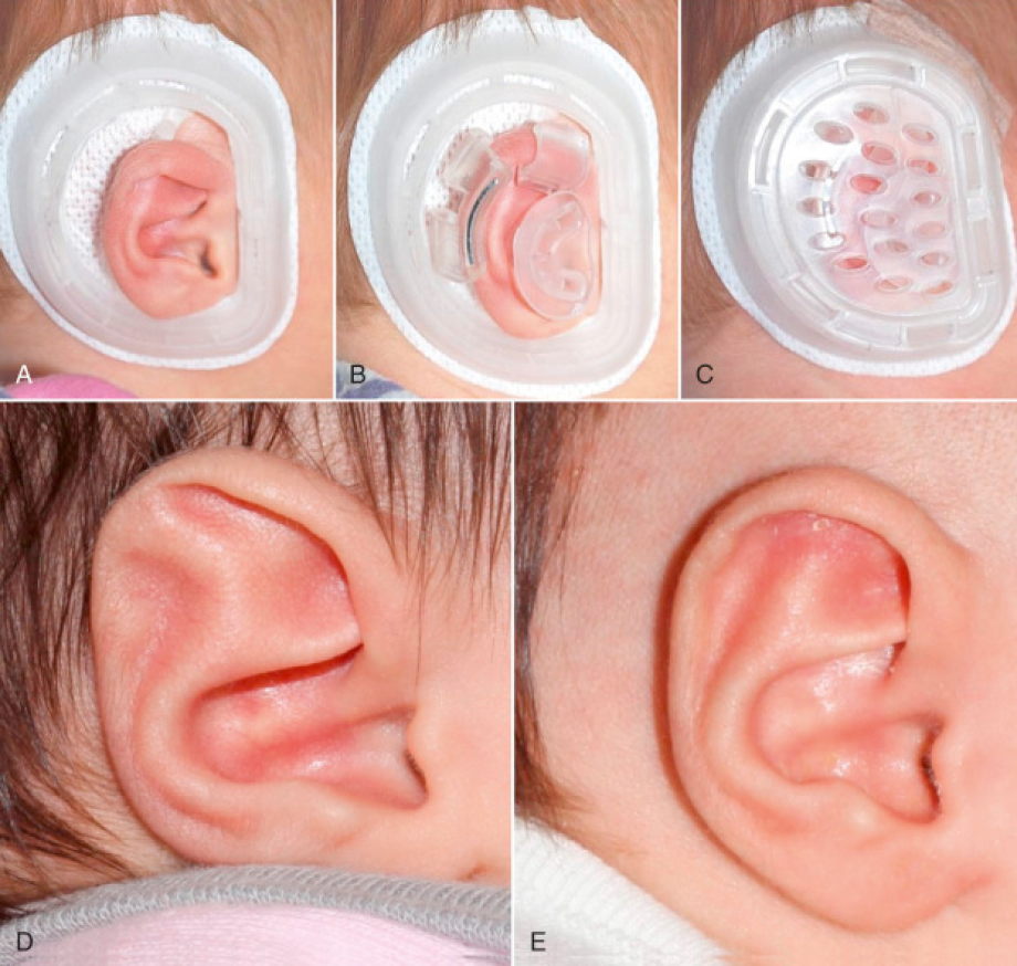 EarWell Yöntemi 2 yas erkek bebek